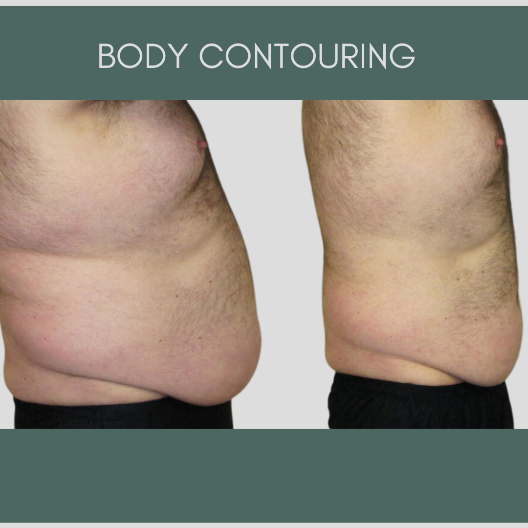 Gold Accelerated Weightloss Package + Body Contour