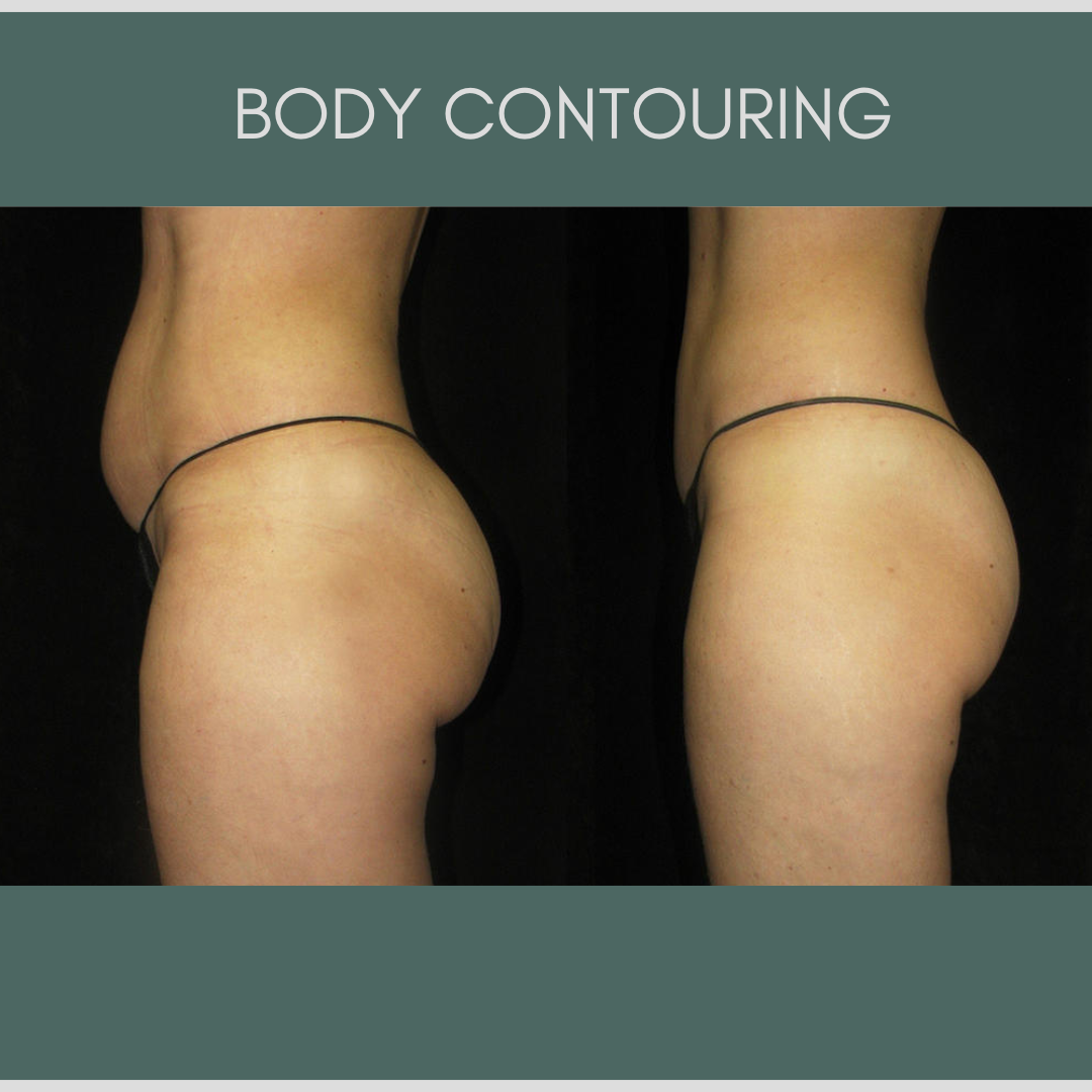 Gold Accelerated Weightloss Package + Body Contour