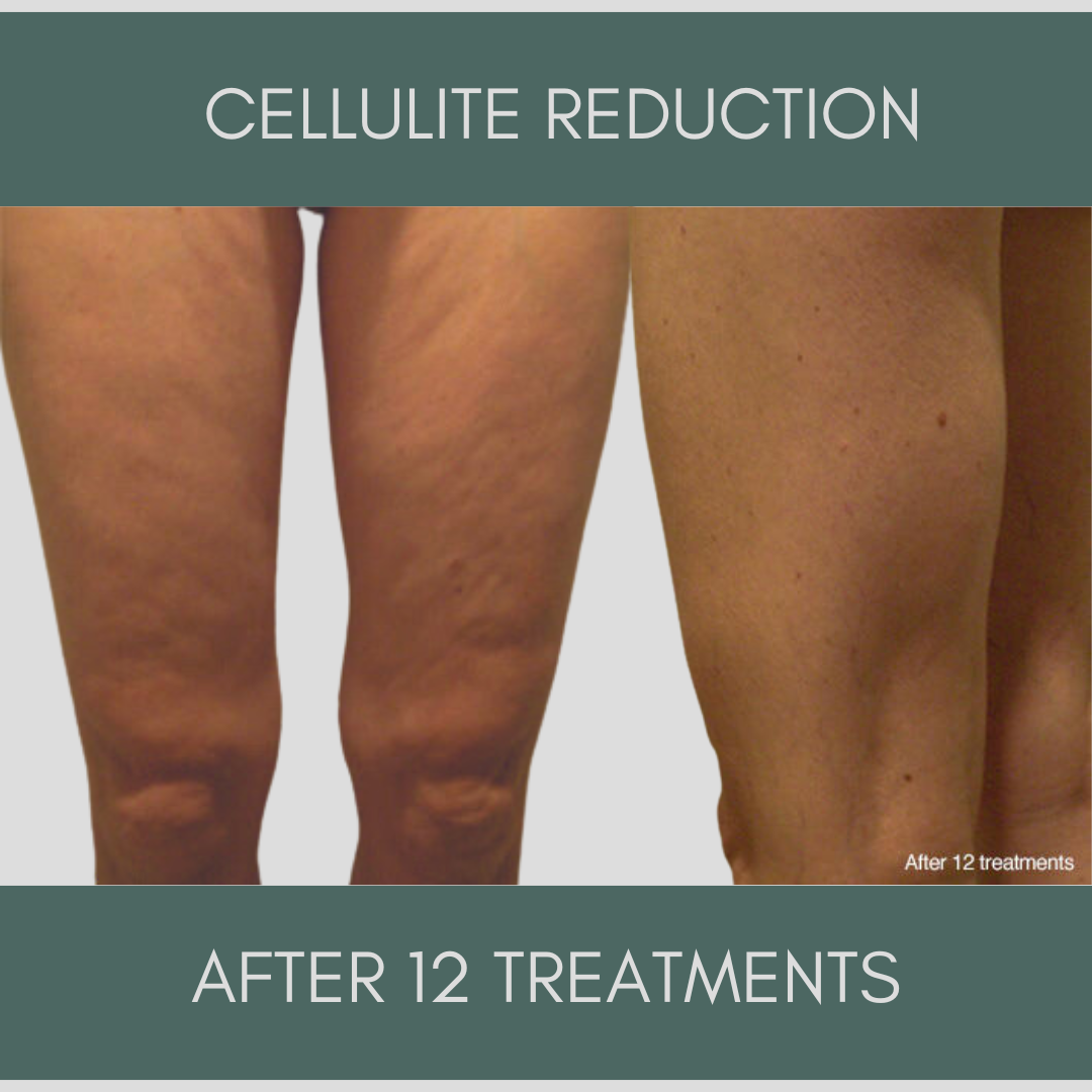 Gold Accelerated Weightloss Package + Body Contour